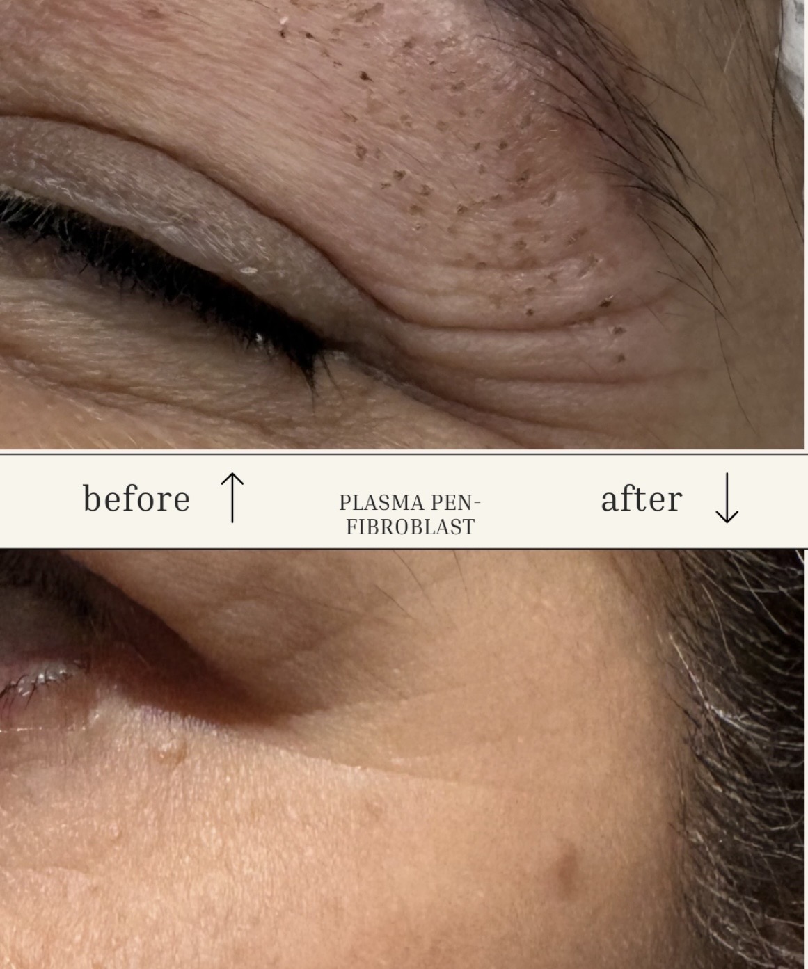 Laser hair removal treatment at Maison One