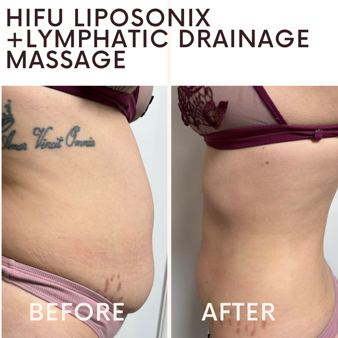 Plasma Pen fibroblast skin tightening treatment